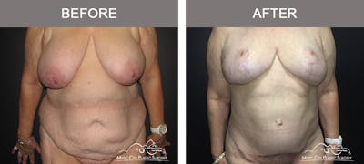 Body Lift Before & After Gallery - Patient 153381 - Image 1
