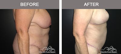 Body Lift Before & After Gallery - Patient 153381 - Image 2