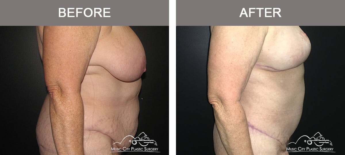 Body Lift Before & After Gallery - Patient 153381 - Image 2