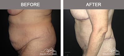 Body Lift Before & After Gallery - Patient 153381 - Image 3