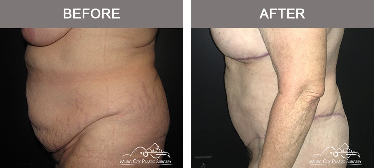 Body Lift Before & After Gallery - Patient 153381 - Image 3