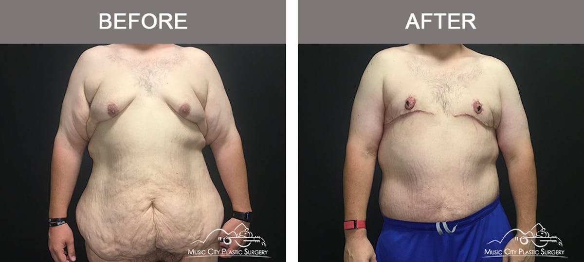 BodyLift Before & After Gallery - Patient 342853 - Image 1