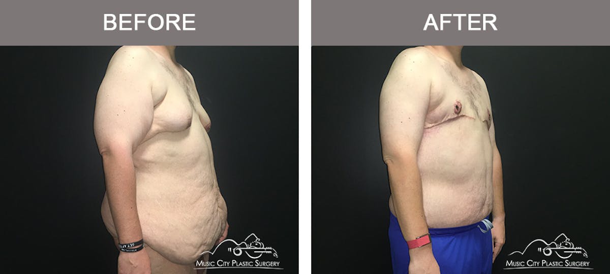 BodyLift Before & After Gallery - Patient 342853 - Image 2