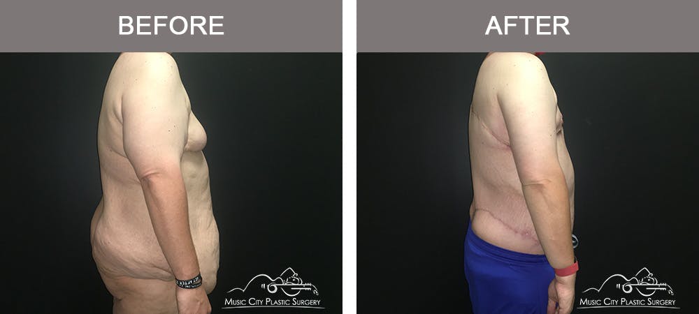 BodyLift Before & After Gallery - Patient 342853 - Image 3