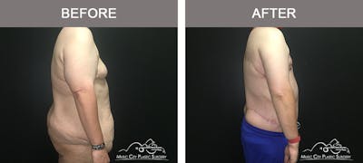 BodyLift Before & After Gallery - Patient 342853 - Image 3