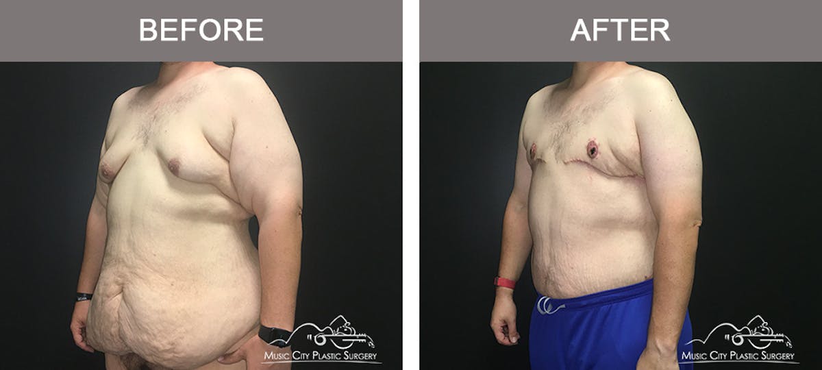 BodyLift Before & After Gallery - Patient 342853 - Image 4