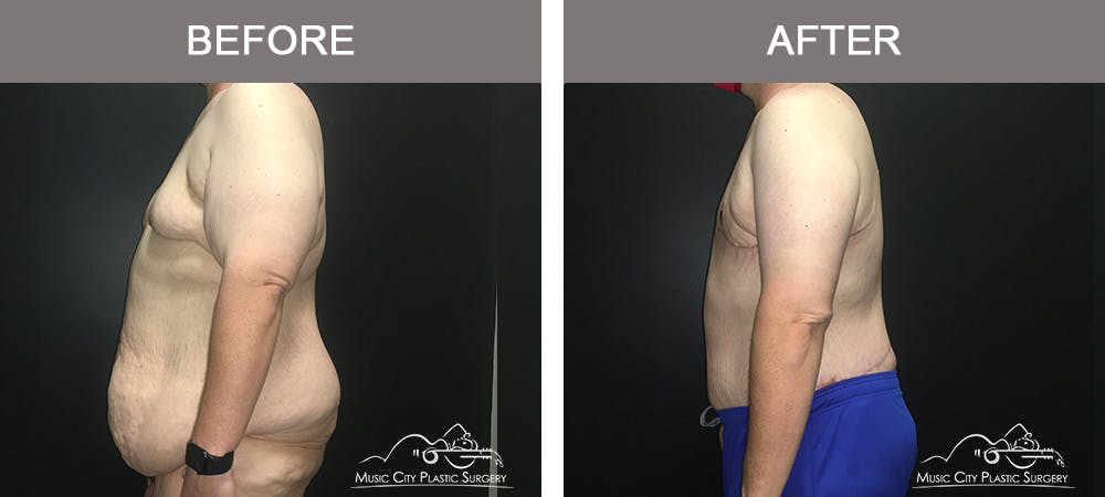 BodyLift Before & After Gallery - Patient 342853 - Image 5