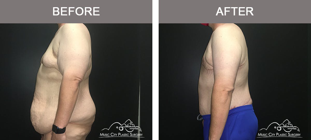 BodyLift Before & After Gallery - Patient 342853 - Image 5