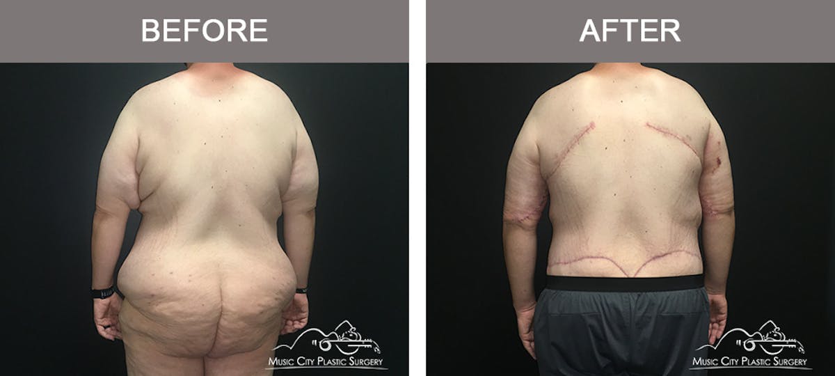 BodyLift Before & After Gallery - Patient 342853 - Image 6