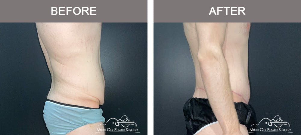BodyLift Before & After Gallery - Patient 196678 - Image 3