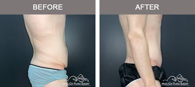 BodyLift Before & After Gallery - Patient 196678 - Image 3
