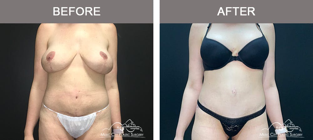 Body Lift Before & After Gallery - Patient 296329 - Image 1