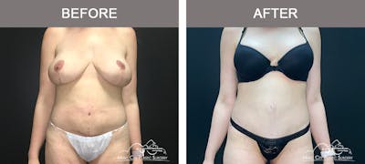 Body Lift Before & After Gallery - Patient 296329 - Image 1