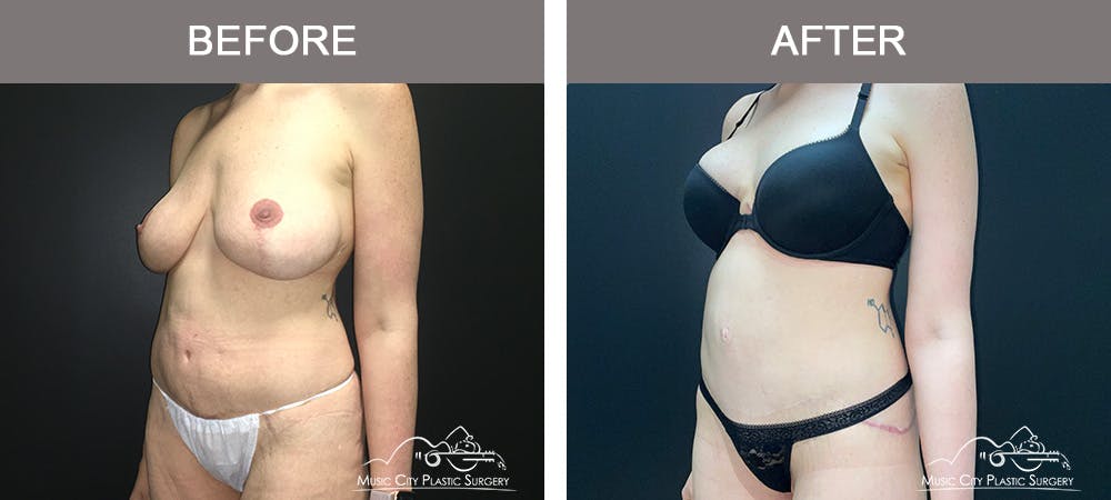 Body Lift Before & After Gallery - Patient 296329 - Image 2