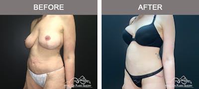 Body Lift Before & After Gallery - Patient 296329 - Image 2