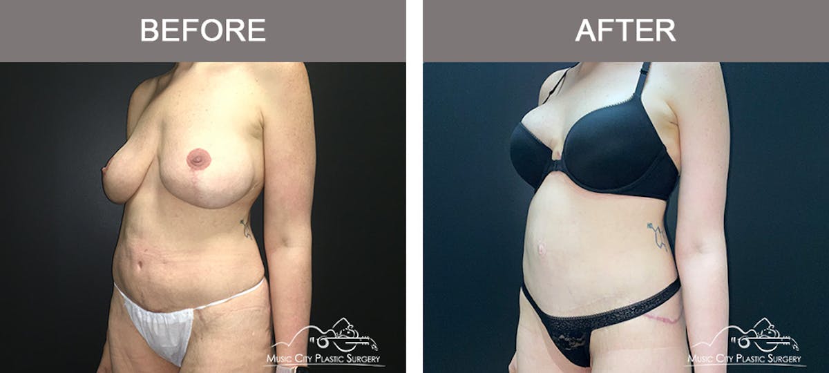 Body Lift Before & After Gallery - Patient 296329 - Image 2