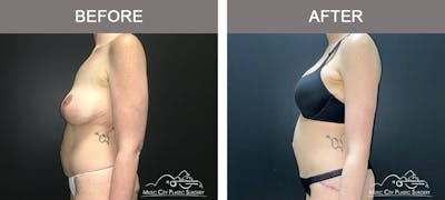 Body Lift Before & After Gallery - Patient 296329 - Image 3