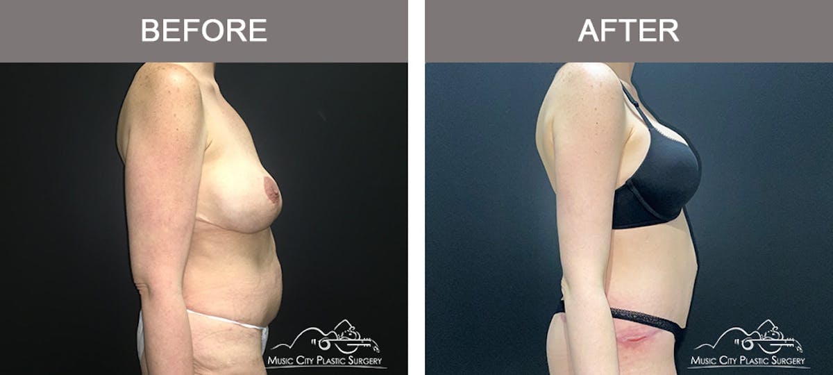 Body Lift Before & After Gallery - Patient 296329 - Image 4