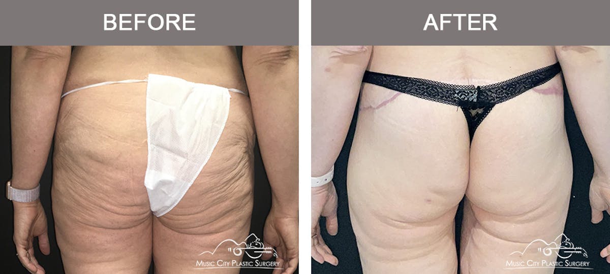 Body Lift Before & After Gallery - Patient 296329 - Image 5