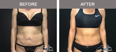 Body Lift Before & After Gallery - Patient 255581 - Image 1