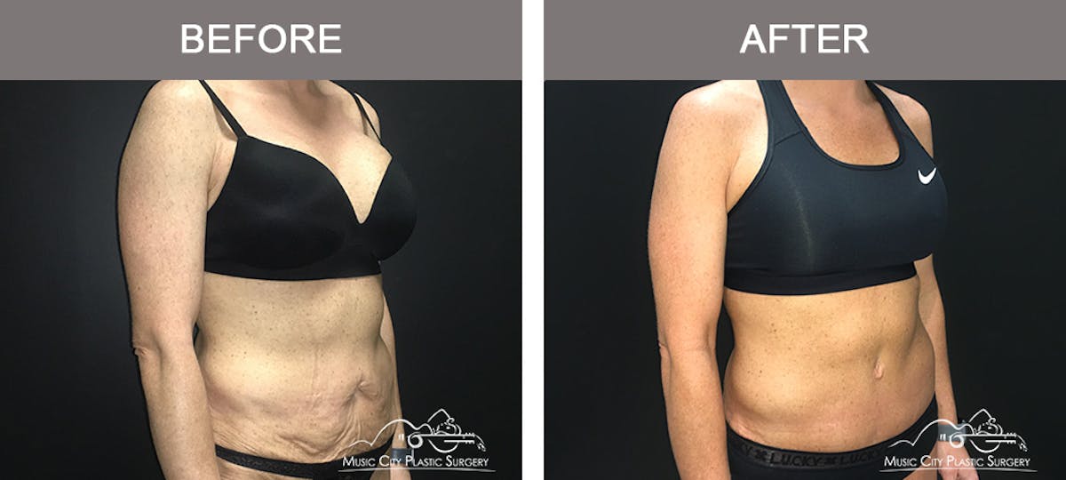 Body Lift Before & After Gallery - Patient 255581 - Image 2