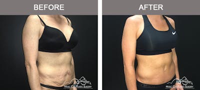 Body Lift Before & After Gallery - Patient 255581 - Image 2