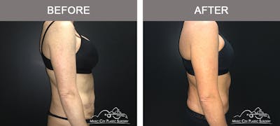 Body Lift Before & After Gallery - Patient 255581 - Image 3
