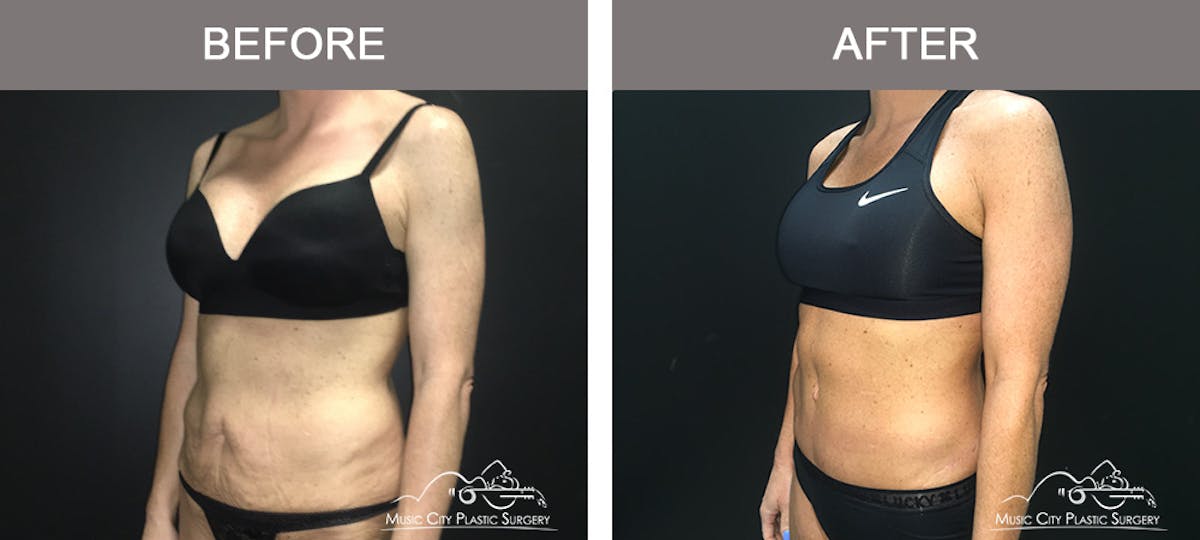 Body Lift Before & After Gallery - Patient 255581 - Image 4