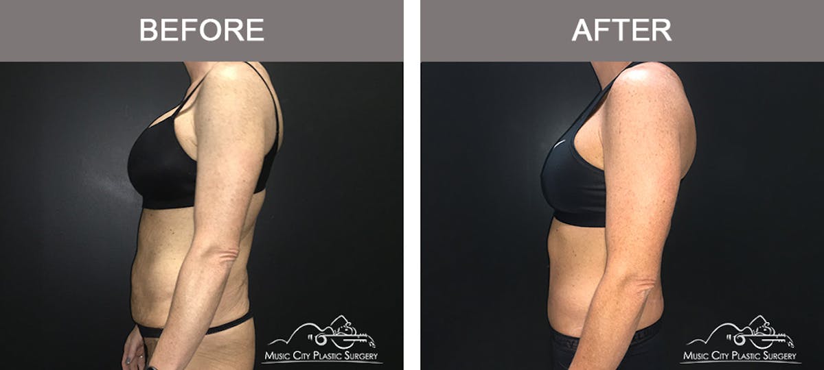 Body Lift Before & After Gallery - Patient 255581 - Image 5