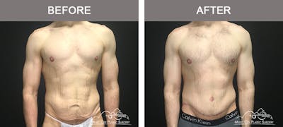 BodyLift Before & After Gallery - Patient 231118 - Image 1