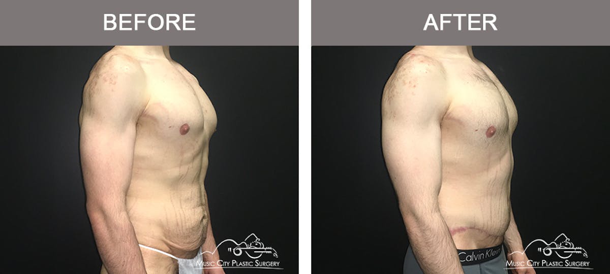 BodyLift Before & After Gallery - Patient 231118 - Image 2