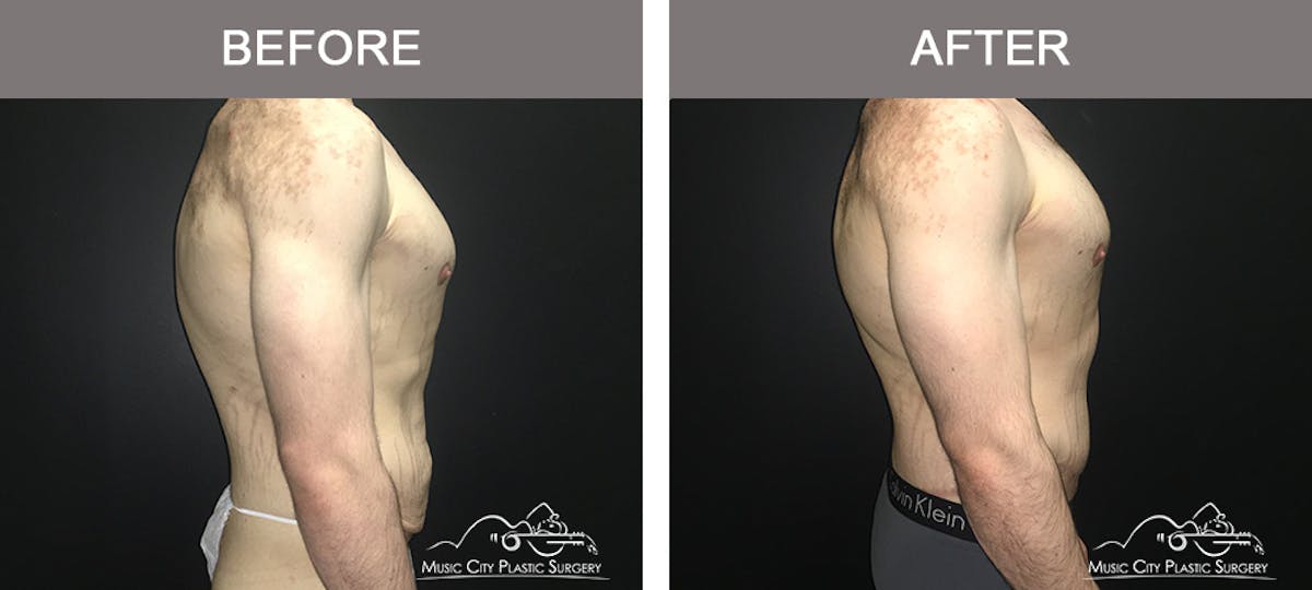 BodyLift Before & After Gallery - Patient 231118 - Image 3