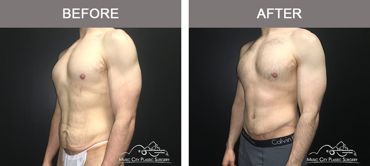 BodyLift Before & After Gallery - Patient 231118 - Image 4