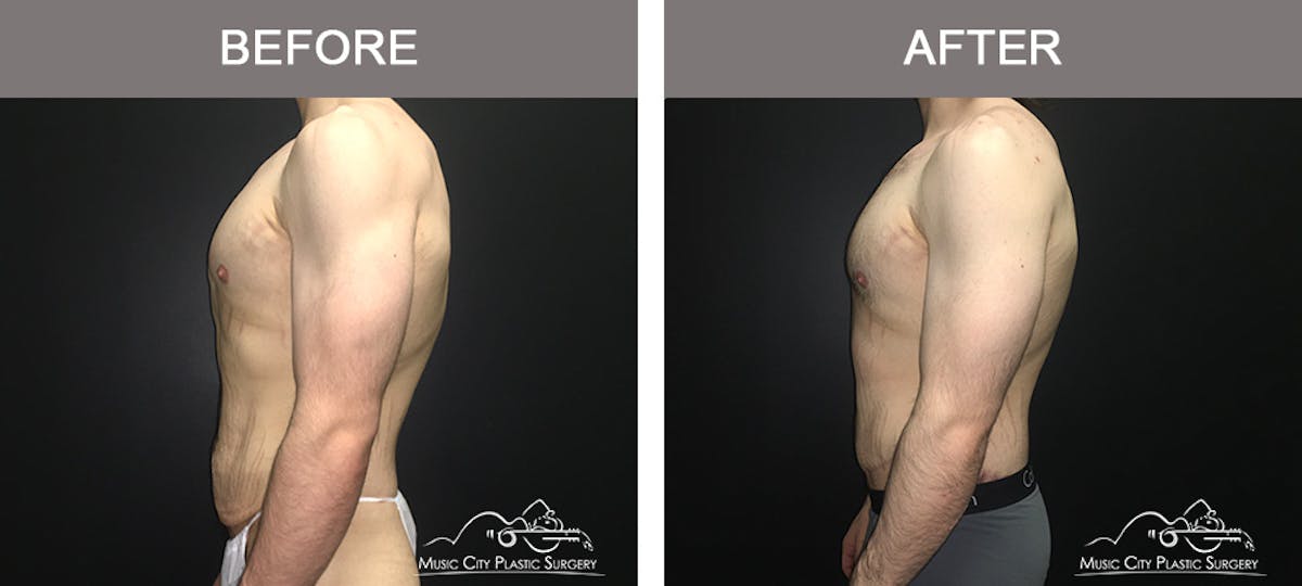 BodyLift Before & After Gallery - Patient 231118 - Image 5