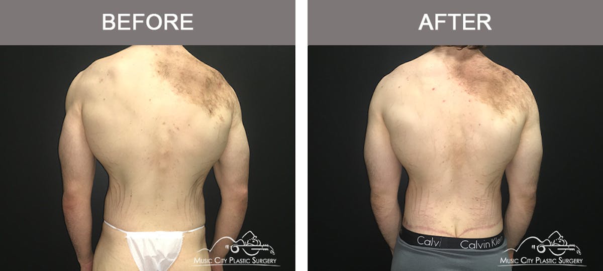 BodyLift Before & After Gallery - Patient 231118 - Image 6