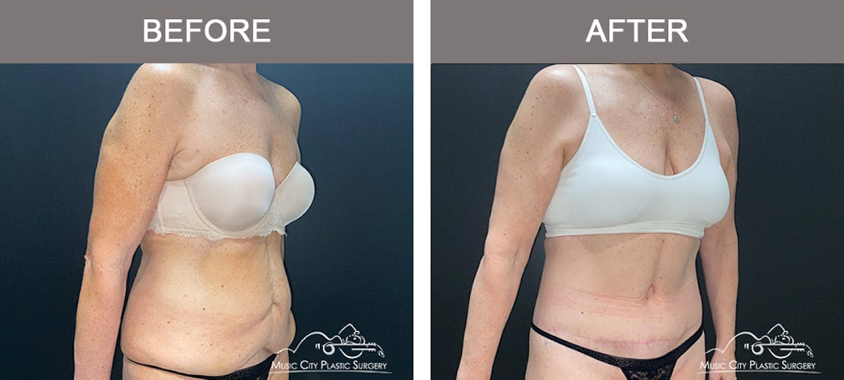 Body Lift Before & After Gallery - Patient 291223 - Image 1