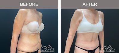 Body Lift Before & After Gallery - Patient 291223 - Image 1
