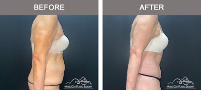 Body Lift Before & After Gallery - Patient 291223 - Image 2