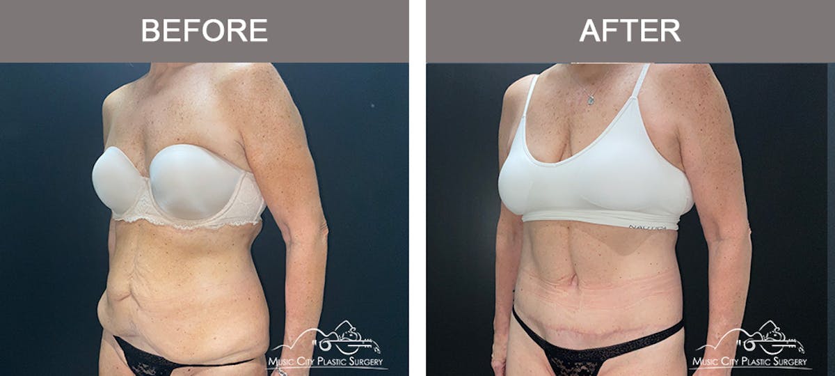 Body Lift Before & After Gallery - Patient 291223 - Image 3