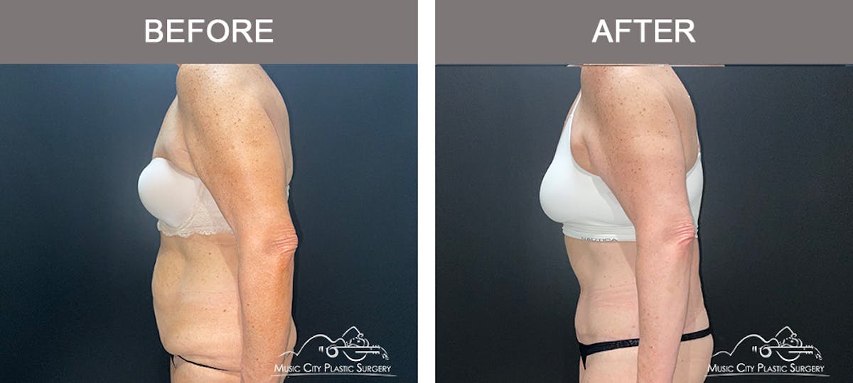 Body Lift Before & After Gallery - Patient 291223 - Image 4