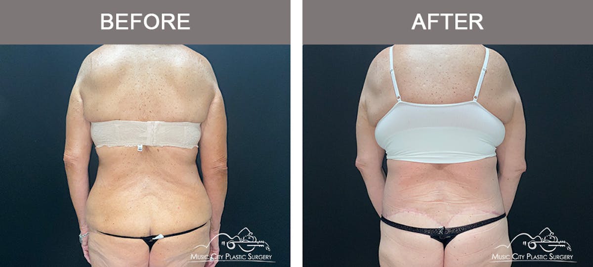 Body Lift Before & After Gallery - Patient 291223 - Image 5