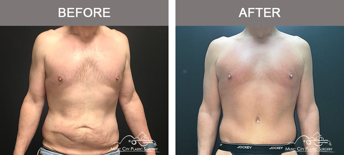 BodyLift Before & After Gallery - Patient 114678 - Image 1