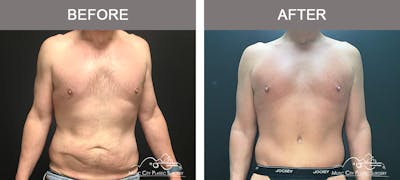 BodyLift Before & After Gallery - Patient 114678 - Image 1