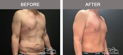 BodyLift Before & After Gallery - Patient 114678 - Image 2