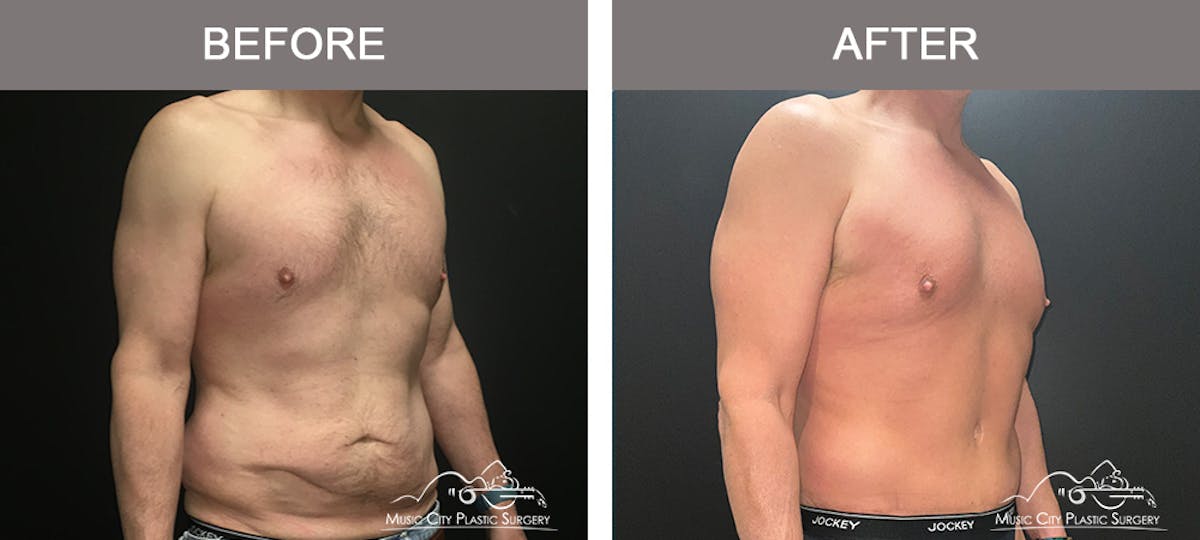 BodyLift Before & After Gallery - Patient 114678 - Image 2