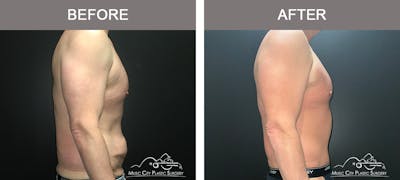 BodyLift Before & After Gallery - Patient 114678 - Image 3