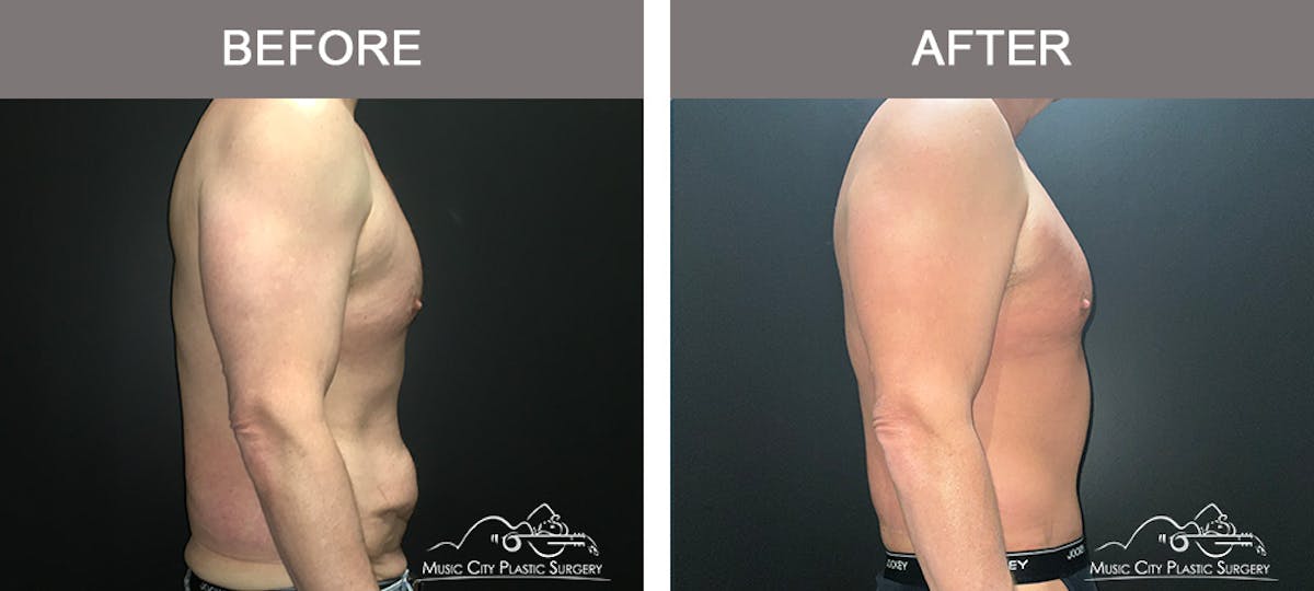 BodyLift Before & After Gallery - Patient 114678 - Image 3
