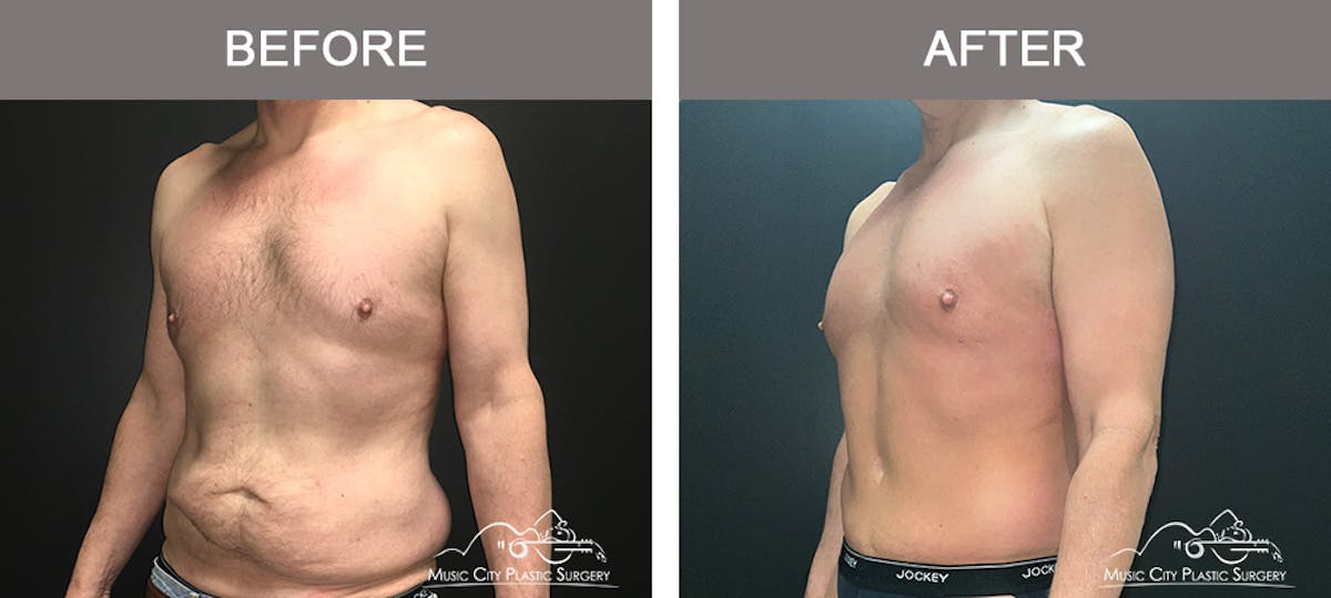BodyLift Before & After Gallery - Patient 114678 - Image 4