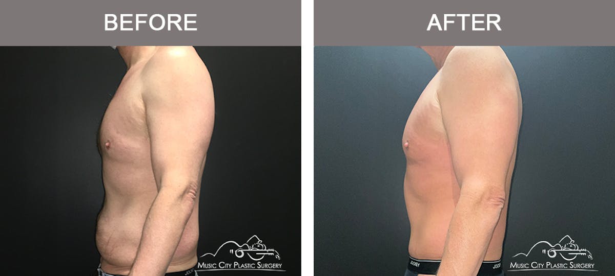 BodyLift Before & After Gallery - Patient 114678 - Image 5