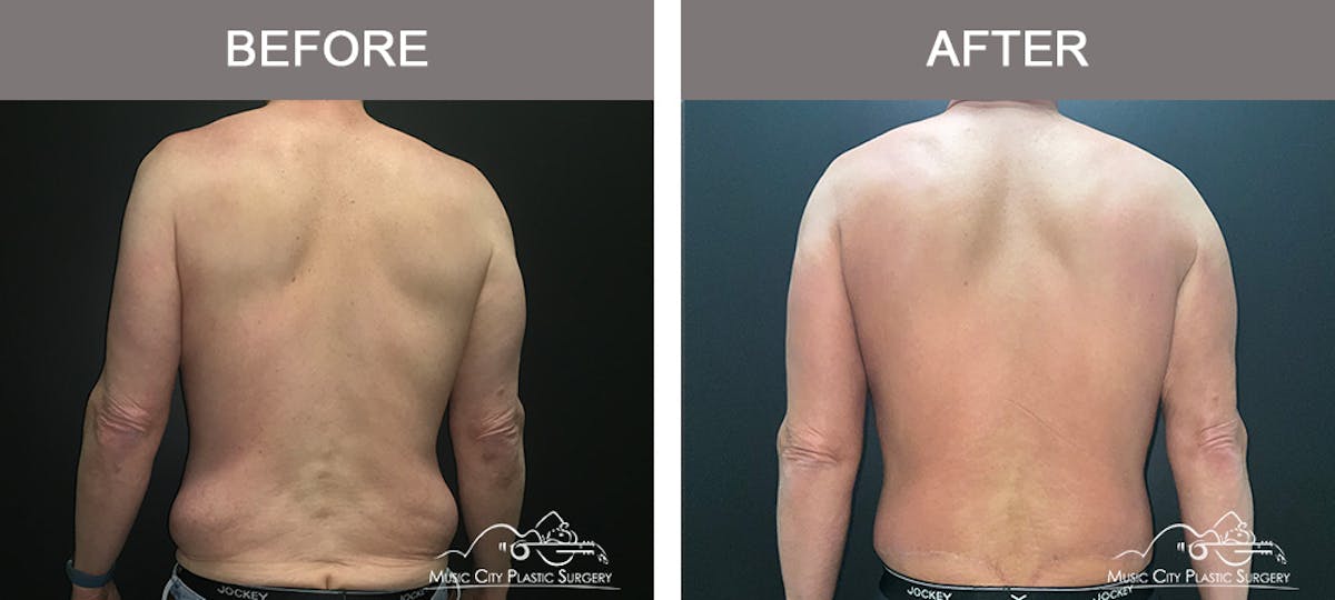 BodyLift Before & After Gallery - Patient 114678 - Image 6